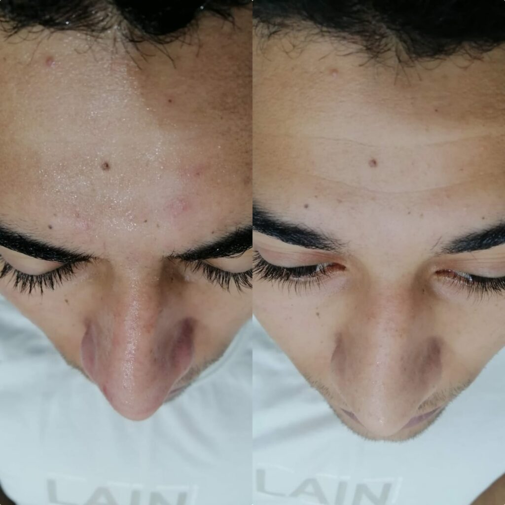 سياحة علاجية نتوياج للبشرة للرجال